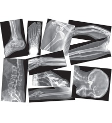 Broken Bones X-Ray Set, Pack of 15